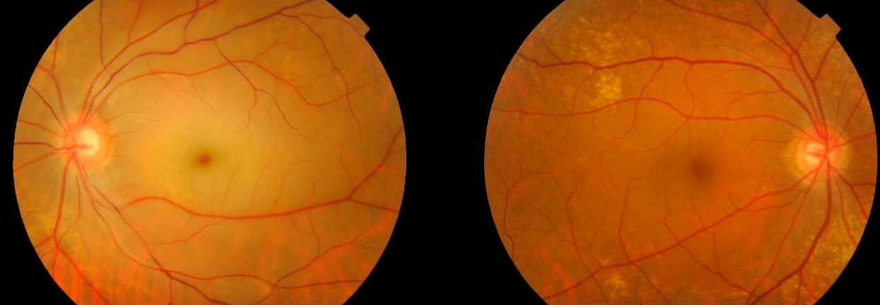 Paciente afecto de una obstrucción de la arteria central de la retina. Observese la diferencia de coloración entre la retina de la izquierda (afecta) respecto a la de la derecha
