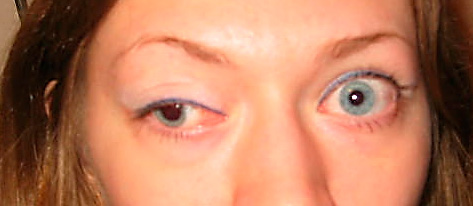 Paciente con una parálisis completa del III par craneal, presenta desviación hacia fuera y abajo, ptosis palpebral y dilatación pupilar.