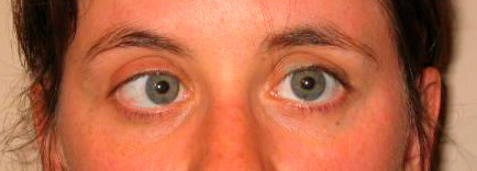 Paciente con una parálisis del VI par craneal. 