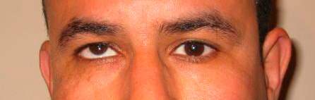 Paciente con un estrabismo vertical