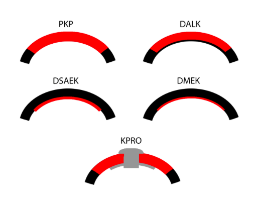 Tipos de trasplante de córnea