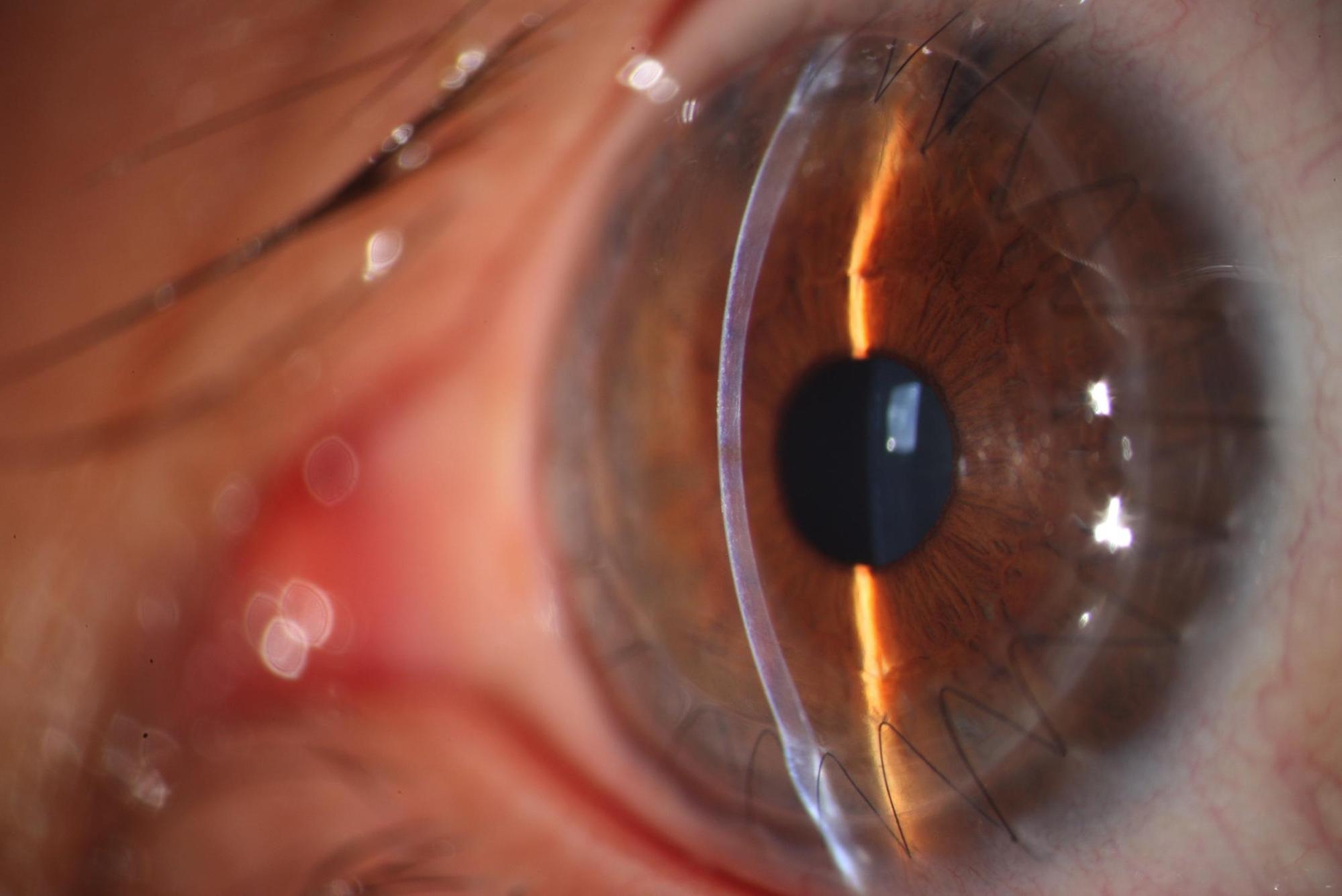 Paciente operado con un trasplante de cornea penetrante y sutura continua